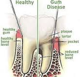 prevent gum disease