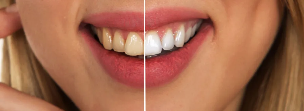 After Before Teeth Whitening Services in St. George, UT