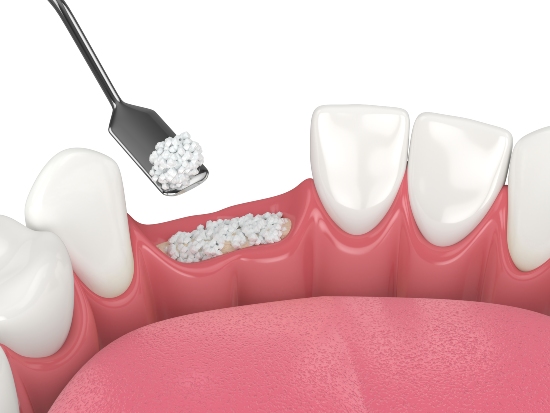 Safe and Effective Bone Grafting Services in St. George, UT